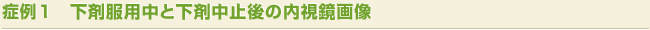下剤服用中と下剤中止後の内視鏡画像""