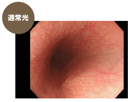 通常光の食道の内視鏡画像