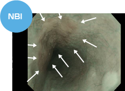 NBI