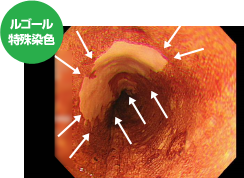 ルゴール特殊染色