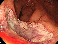 直腸潰瘍