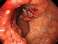 大腸の半分を占拠する大きな進行大腸がんです。