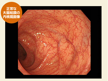 胃がん 症状 胃腸炎 胃がん 症状 胃腸炎