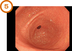 胃がん 噴門部 胃がん 噴門部