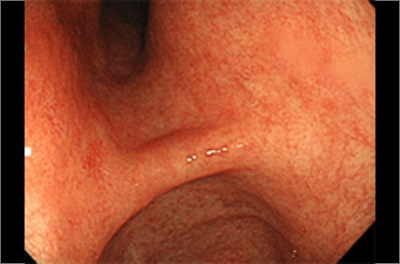 萎縮性胃炎の胃カメラ写真