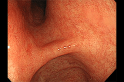 萎縮性胃炎が目立つ、内視鏡写真