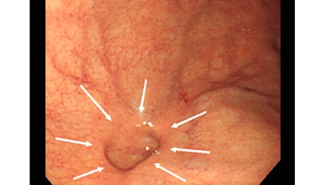 胃穹窿部（胃の上部）にみられた、憩室の内視鏡写真