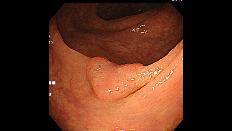 大腸腺腫（ポリープ）の内視鏡写真