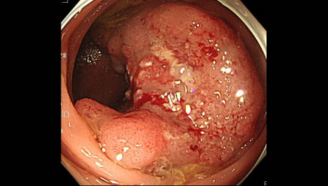 進行大腸がんイメージ