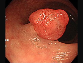 内視鏡で切除可能な早期大腸がんの内視鏡画像