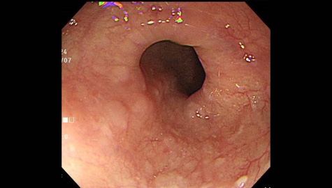 早期食道がんの内視鏡画像