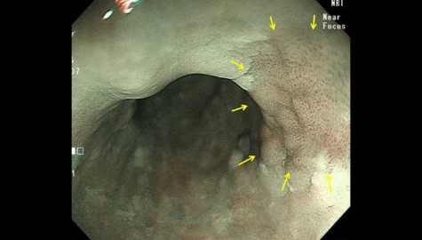 早期食道がんに豊富にある血管模様を強調できるNBI
