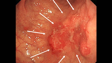 胃の前庭部～胃角部（胃の出口に近い部分）にかけて大きな胃がん