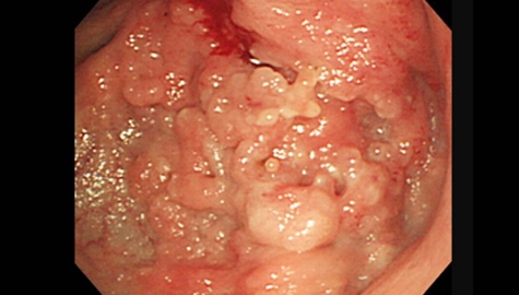 スキルス胃がんの内視鏡画像