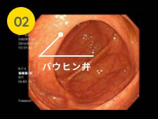 大腸 内 視 鏡 検査 で わかる 病気