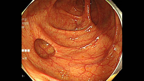大腸憩室の内視鏡画像