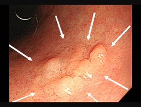胃腺腫の内視鏡写真