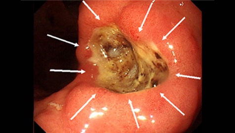 大きくて深い胃潰瘍