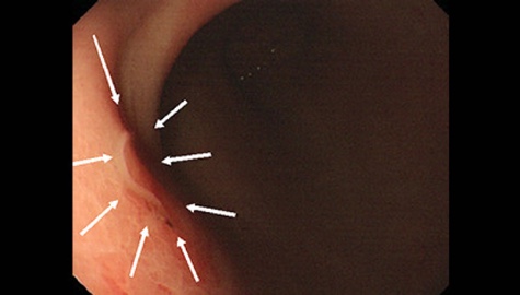 アニサキス症の内視鏡画像