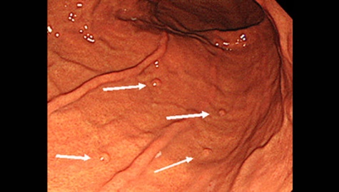 胃底腺ポリープ