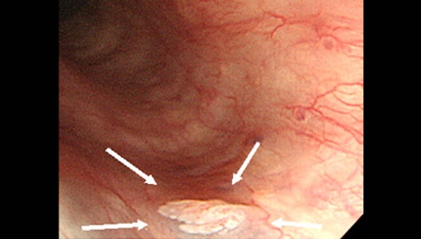 食道乳頭腫の内視鏡写真