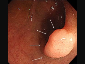 十二指腸腺腫の内視鏡写真