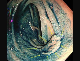 十二指腸腺腫のインジゴカルミン染色