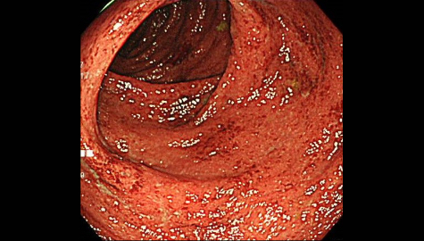 潰瘍性大腸炎の内視鏡写真