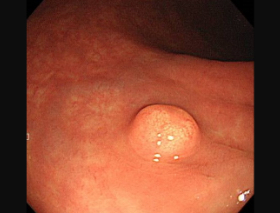 直腸カルチノイドの内視鏡画像