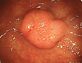 切除可能な大腸ポリープの内視鏡画像