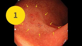 横行結腸に20mmの病変