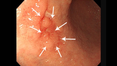 早期胃がんの症例