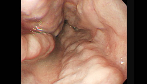 食道静脈瘤の内視鏡写真