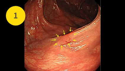 6mm大の大腸ポリープ