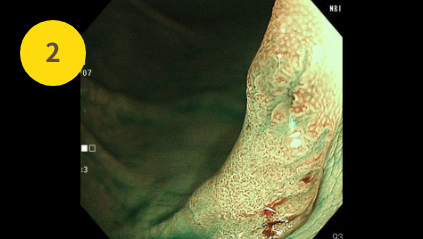NBI（狭帯域光観察）に切り換えたハイビジョン内視鏡画像