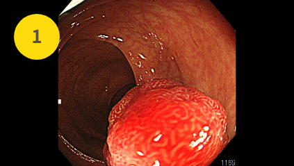 横行結腸の大腸ポリープ