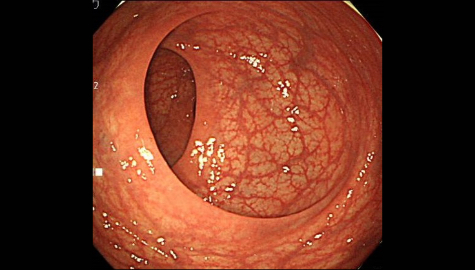 正常な大腸の内視鏡画像
