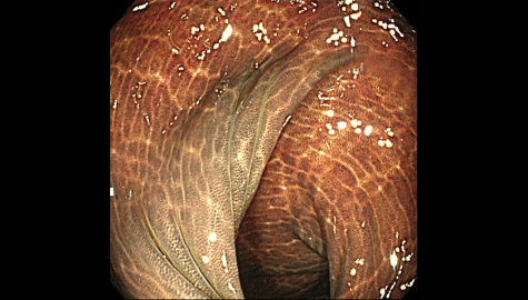 大腸メラノーシスの内視鏡画像
