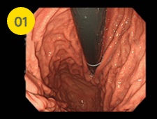 胃噴門部を観察