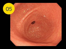 胃幽門部を詳細に観察