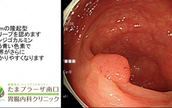 当クリニックで行った内視鏡治療①