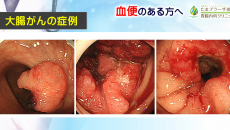 血便について