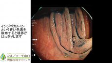 当クリニックで行った内視鏡治療②