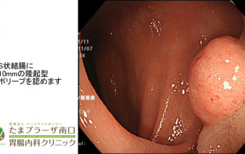 当クリニックで行った内視鏡⑤