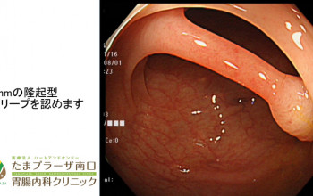 当クリニックで行った内視鏡治療③