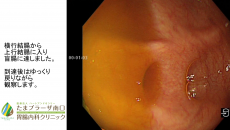 大腸内視鏡検査　内視鏡専門医　挿入の実際　～苦しくなく、痛みに配慮した大腸内視鏡検査～