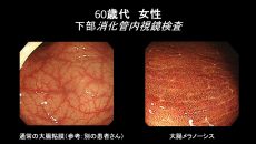 大腸が「ヒョウ柄」－大腸メラノーシスー