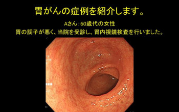 胃がんの治療が何と10分で！！