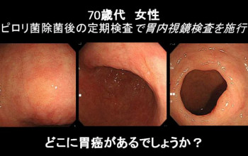 胃内に３個も胃癌が！！