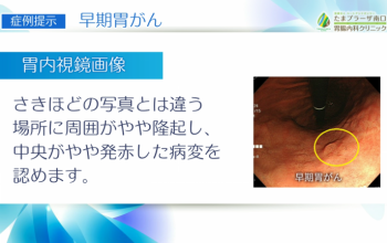 「ピロリ菌を除菌したら、胃がんになりませんよね？」